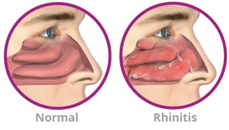 Chronic Rhinitis illustration