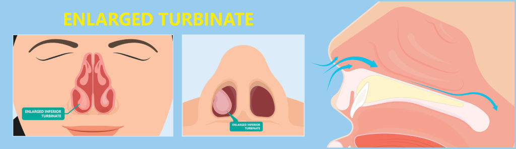 Diagram of a nose showing an enlarged turbinate